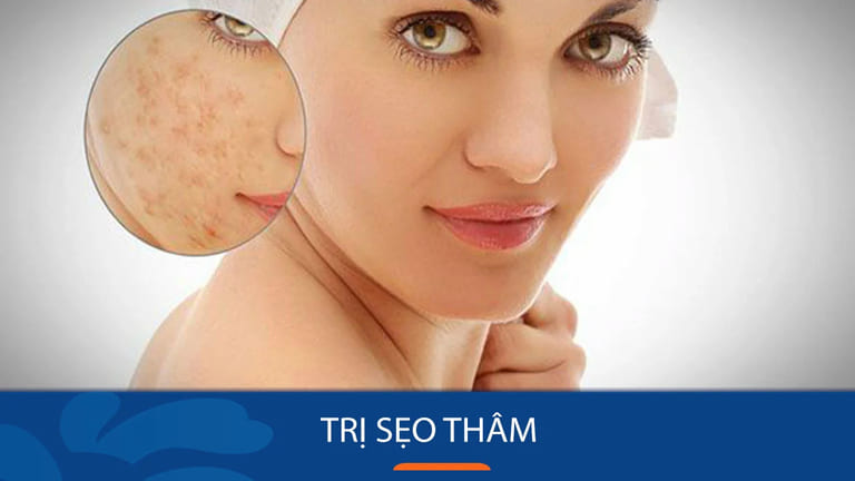 trị sẹo thâm ở đâu tốt nhất khu vực hn