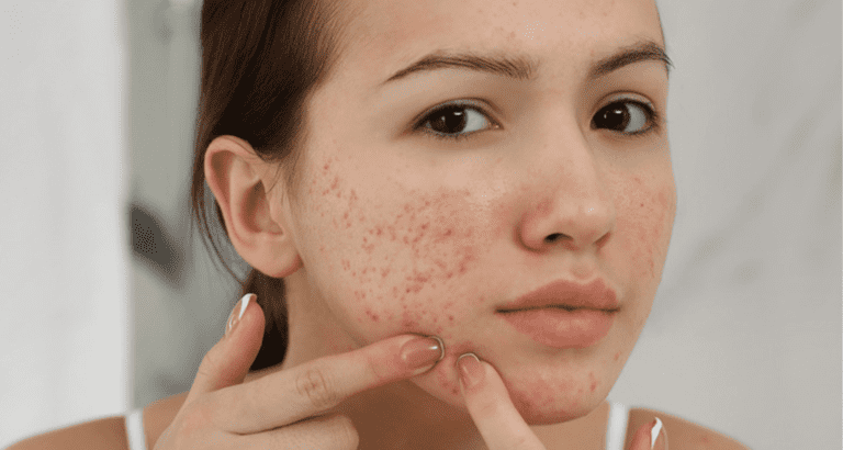 có nên trị mụn ở tuổi dậy thì