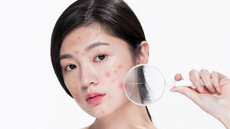 có nên đi spa trị mụn tuổi dậy thì