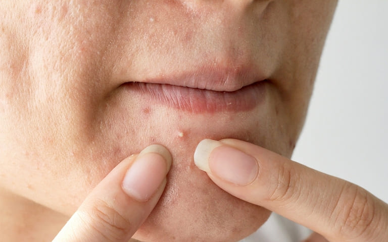 nếu không nặn mụn có tự hết không