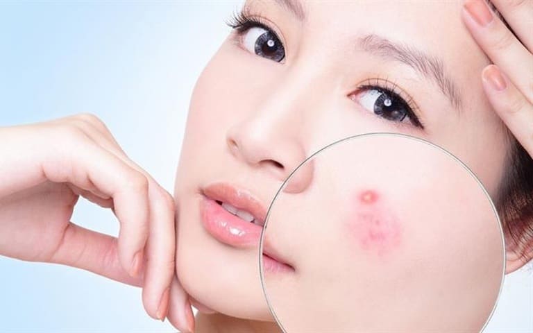 mang thai có nên đi spa nặn mụn