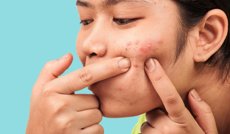 năn mụn bao lâu 1 lần