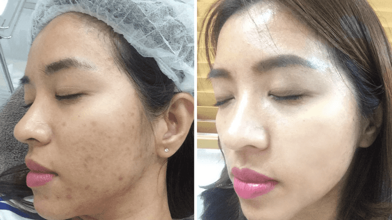 spa trị mụn đầu đen