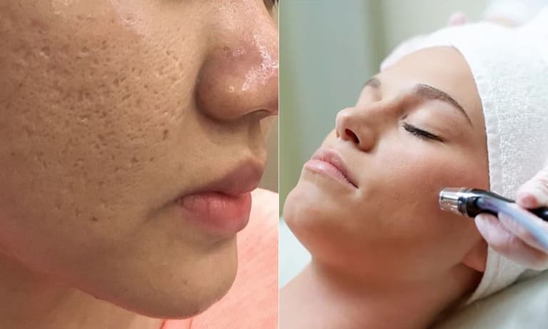 trị sẹo rỗ ở đâu tốt nhất tphcm