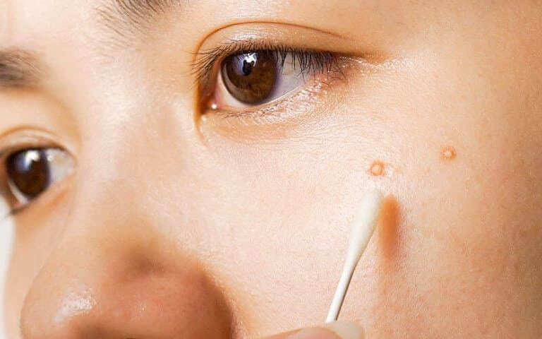 cách trị mụn bằng hồ nước