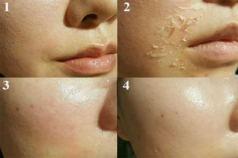 cách trị mụn bằng thuốc bắc 