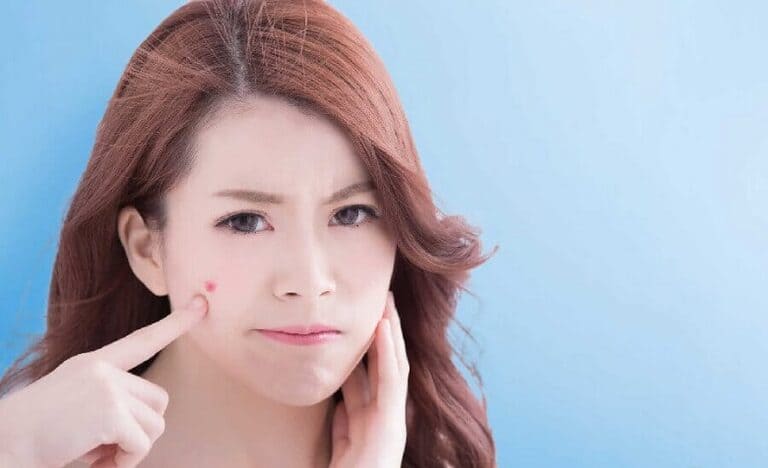 có nên nặn mụn trong ngày đèn đỏ