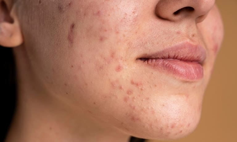 có nên peel da sau khi nặn mụn