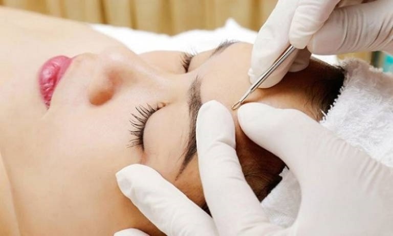 Báo Giá Lấy Nhân Mụn Ở Spa Chi Tiết, Ưu Đãi Tốt Nhất 2024