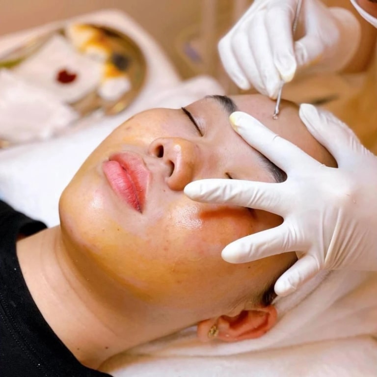 Báo giá lấy mụn ở spa 