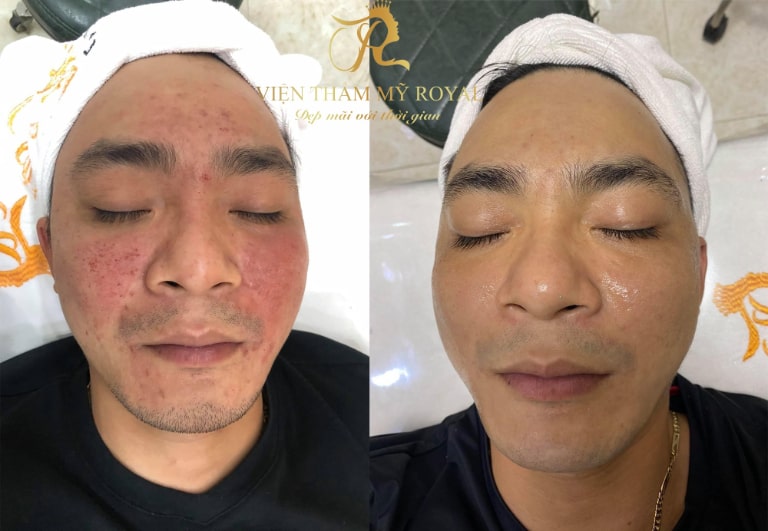 Giảm thiểu tình trạng tái phát mụn và để lại sẹo