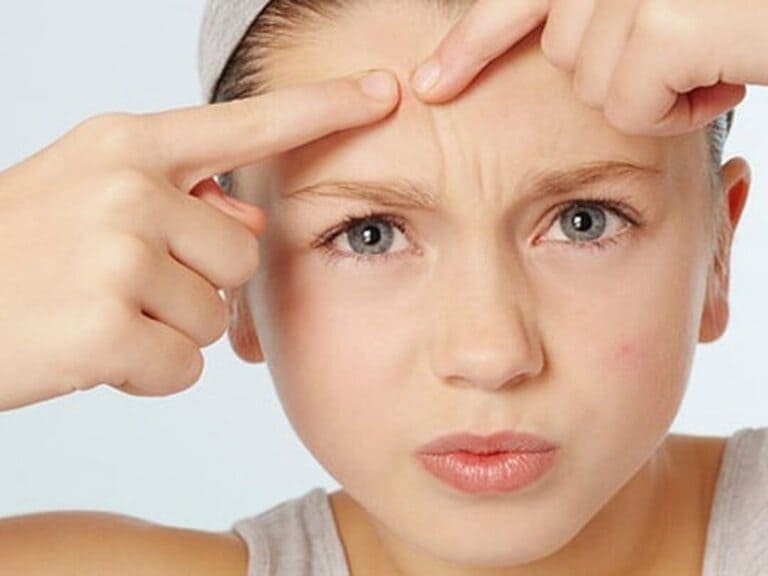 mới nặn mụn không nên ăn gì