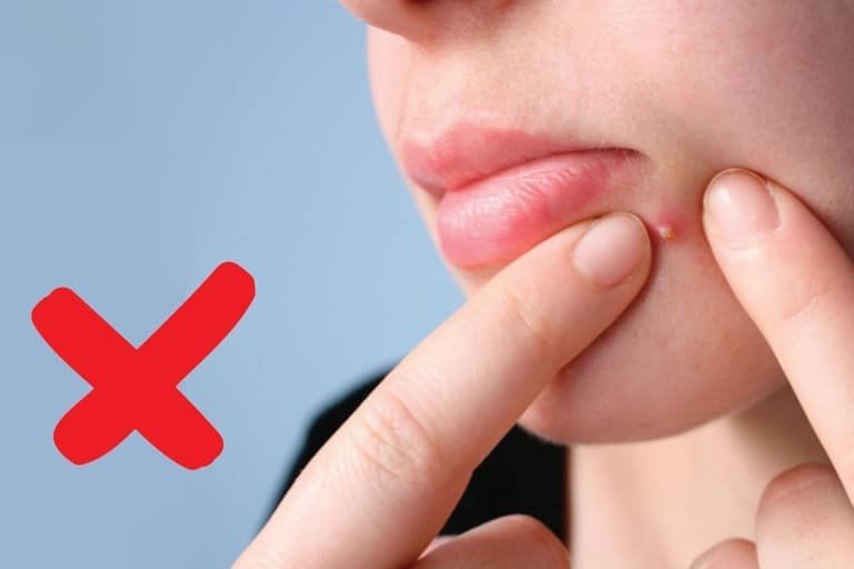 nặn mụn có sao không