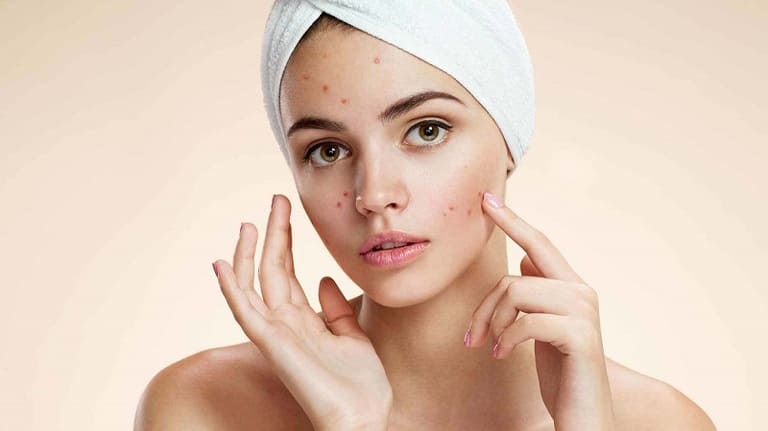 sau khi nặn mụn có nên bôi kem nghệ không