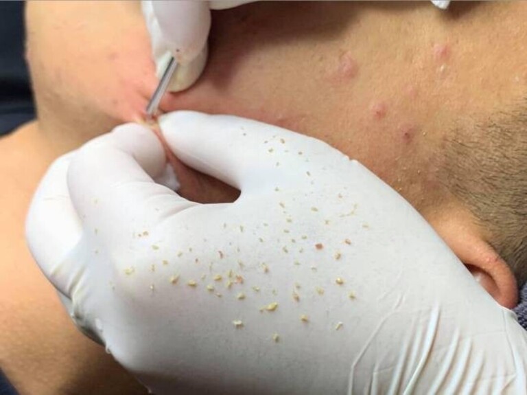 spa nặn mụn quận 10 tốt nhất